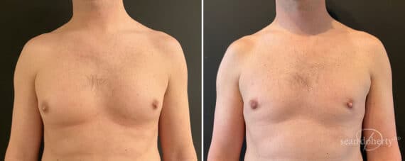 Gynecomastia Before and After Photos in Boston, MA, Patient 10179