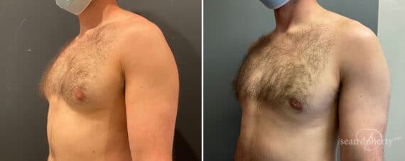 Gynecomastia Before and After Photos in Boston, MA, Patient 10190