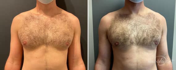 Gynecomastia Before and After Photos in Boston, MA, Patient 10190