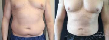 Male Liposuction Before and After Photos in Boston, MA, Patient 10230