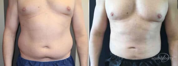 Male Liposuction Before and After Photos in Boston, MA, Patient 10230