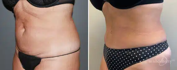 Tummy Tuck Before and After Photos in Boston, MA, Patient 9817