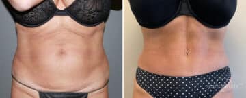 Tummy Tuck Before and After Photos in Boston, MA, Patient 9817