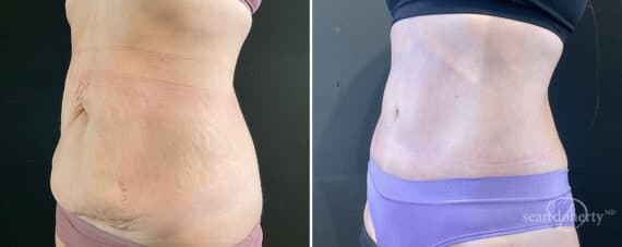 Tummy Tuck Before and After Photos in Boston, MA, Patient 9828