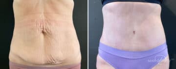 Tummy Tuck Before and After Photos in Boston, MA, Patient 9828