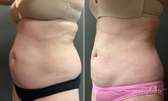 Liposuction Before and After Photos in Boston, MA, Patient 10391