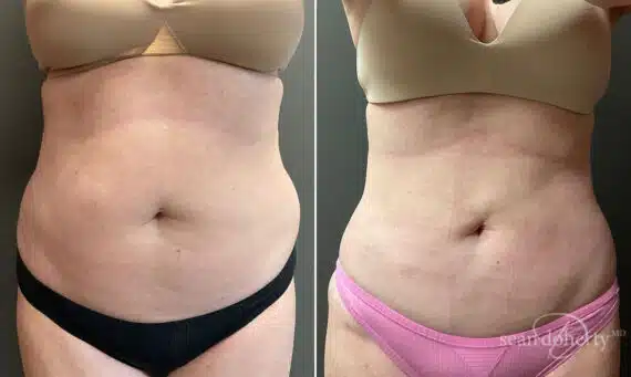 Liposuction Before and After Photos in Boston, MA, Patient 10391