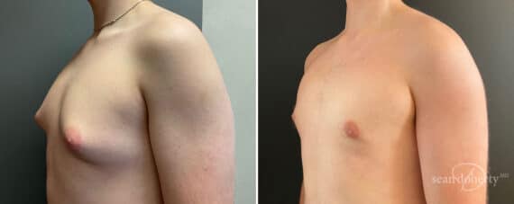 Gynecomastia Before and After Photos in Boston, MA, Patient 10401