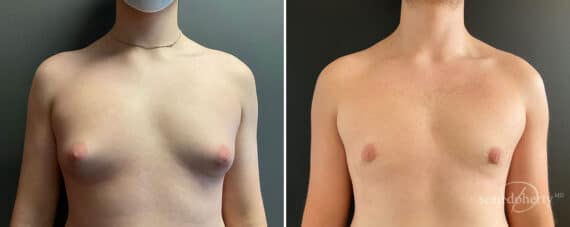 Gynecomastia Before and After Photos in Boston, MA, Patient 10401