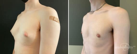 Gynecomastia Before and After Photos in Boston, MA, Patient 10411