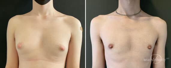 Gynecomastia Before and After Photos in Boston, MA, Patient 10411