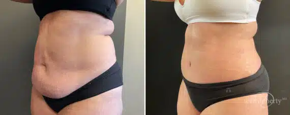 Tummy Tuck Before and After Photos in Boston, MA, Patient 10421