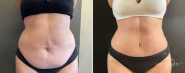 Tummy Tuck Before and After Photos in Boston, MA, Patient 10421