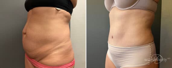 Tummy Tuck Before and After Photos in Boston, MA, Patient 10431