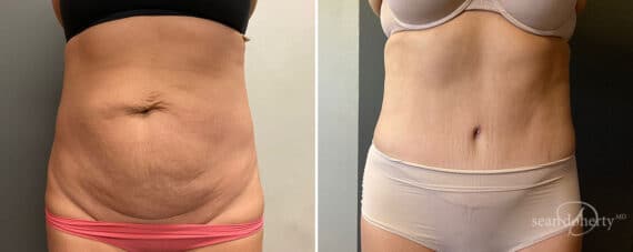 Tummy Tuck Before and After Photos in Boston, MA, Patient 10431