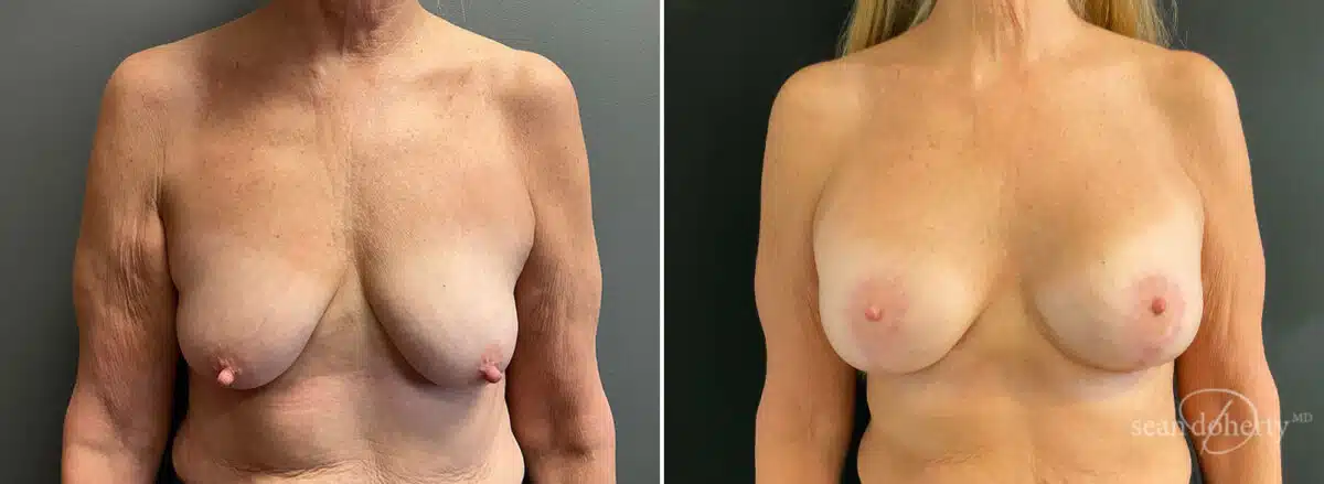 Patient 10441, Breast Lift with Implants Before and After Photos Breast Lift with Implants Before and After Photos in Boston, MA, Patient 10441