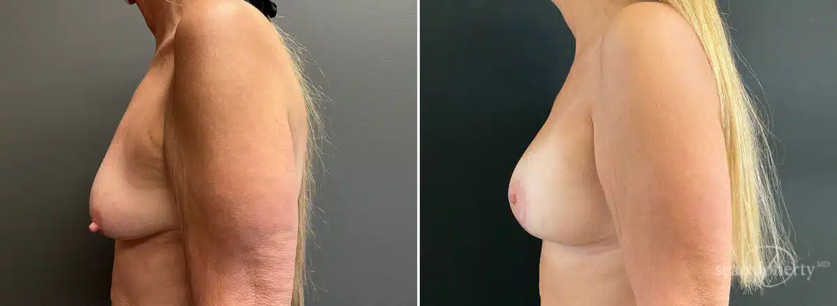 Patient 10441, Breast Lift with Implants Before and After Photos Breast Lift with Implants Before and After Photos in Boston, MA, Patient 10441