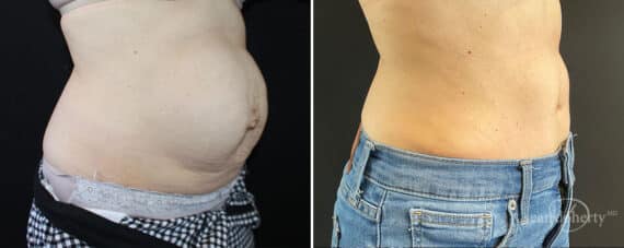 Tummy Tuck Before and After Photos in Boston, MA, Patient 10457