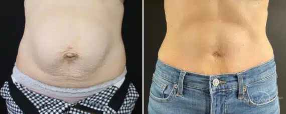 Tummy Tuck Before and After Photos in Boston, MA, Patient 10457