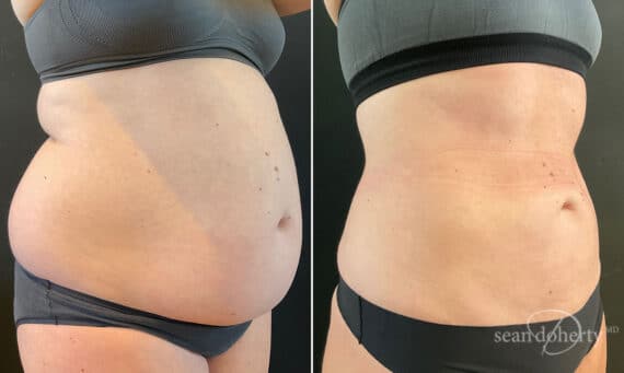 Liposuction Before and After Photos in Boston, MA, Patient 10486