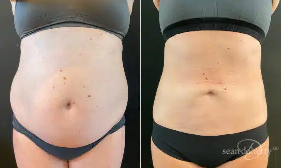 Liposuction Before and After Photos in Boston, MA, Patient 10486