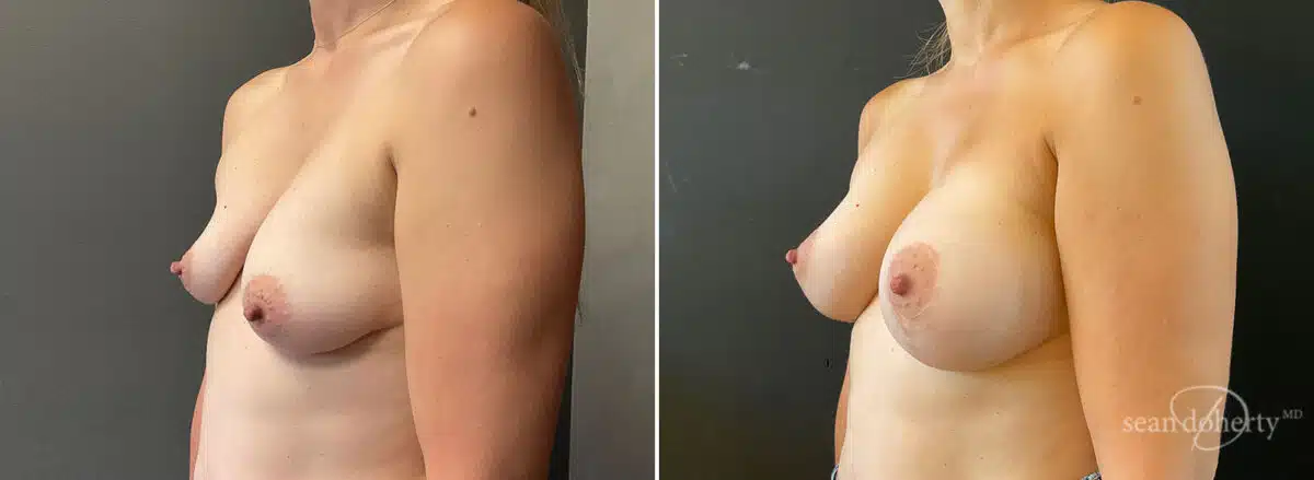 Patient 10507, Breast Lift with Implants Before and After Photos Breast Lift with Implants Before and After Photos in Boston, MA, Patient 10507