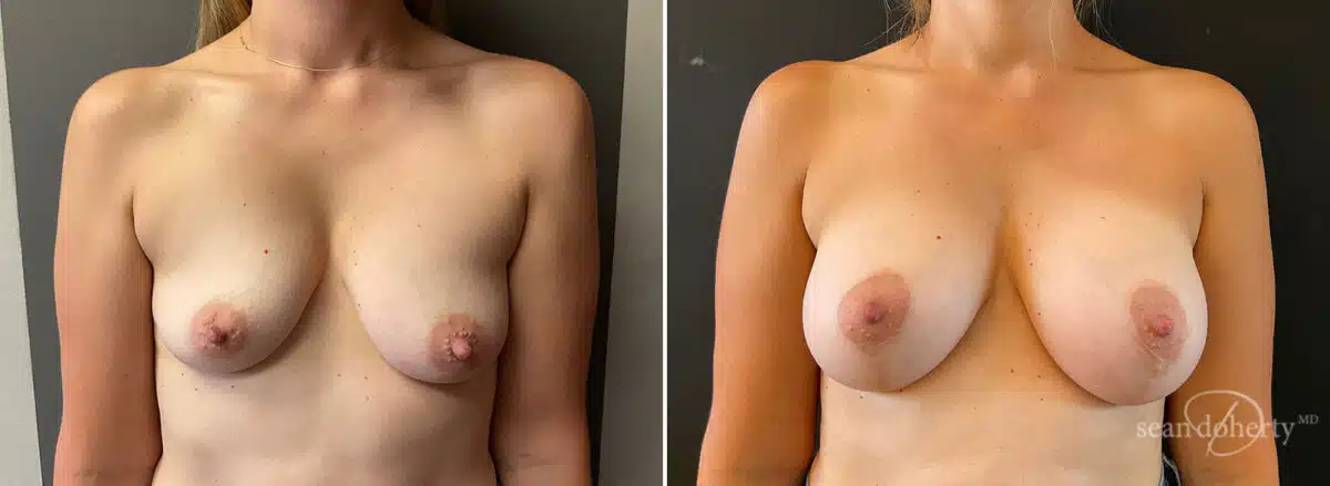 Patient 10507, Breast Lift with Implants Before and After Photos Breast Lift with Implants Before and After Photos in Boston, MA, Patient 10507