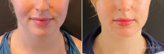 Liposuction Before and After Photos in Boston, MA, Patient 10517