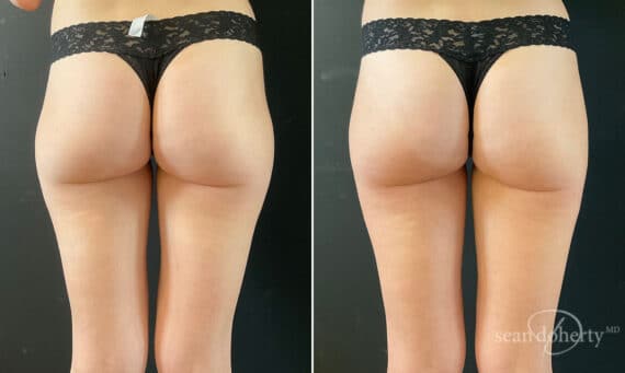 Liposuction Before and After Photos in Boston, MA, Patient 10527