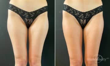 Liposuction Before and After Photos in Boston, MA, Patient 10527