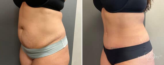 Tummy Tuck Before and After Photos in Boston, MA, Patient 10768