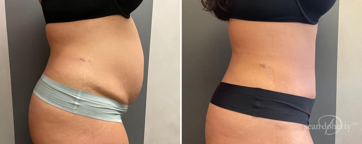 Patient 10768, Tummy Tuck Before and After Photos Tummy Tuck Before and After Photos in Boston, MA, Patient 10768