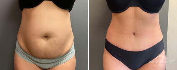 Tummy Tuck Before and After Photos in Boston, MA, Patient 10768