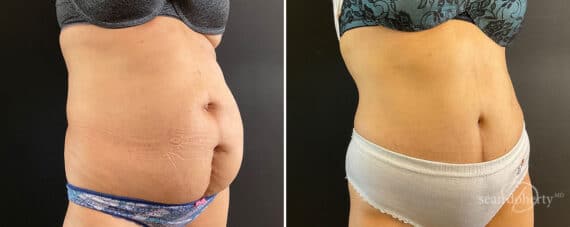 Tummy Tuck Before and After Photos in Boston, MA, Patient 10778