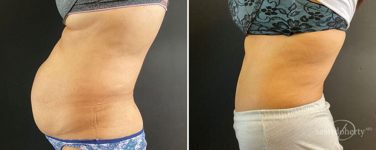 Patient 10778, Tummy Tuck Before and After Photos Tummy Tuck Before and After Photos in Boston, MA, Patient 10778