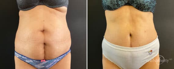 Tummy Tuck Before and After Photos in Boston, MA, Patient 10778