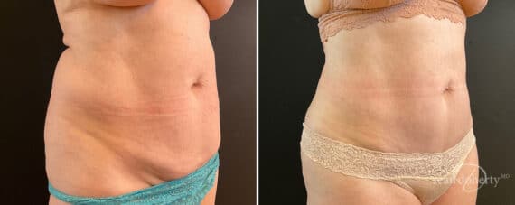 Tummy Tuck Before and After Photos in Boston, MA, Patient 10790