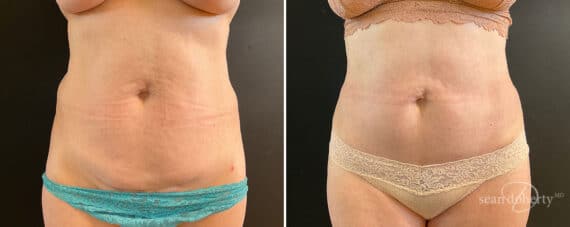 Tummy Tuck Before and After Photos in Boston, MA, Patient 10790