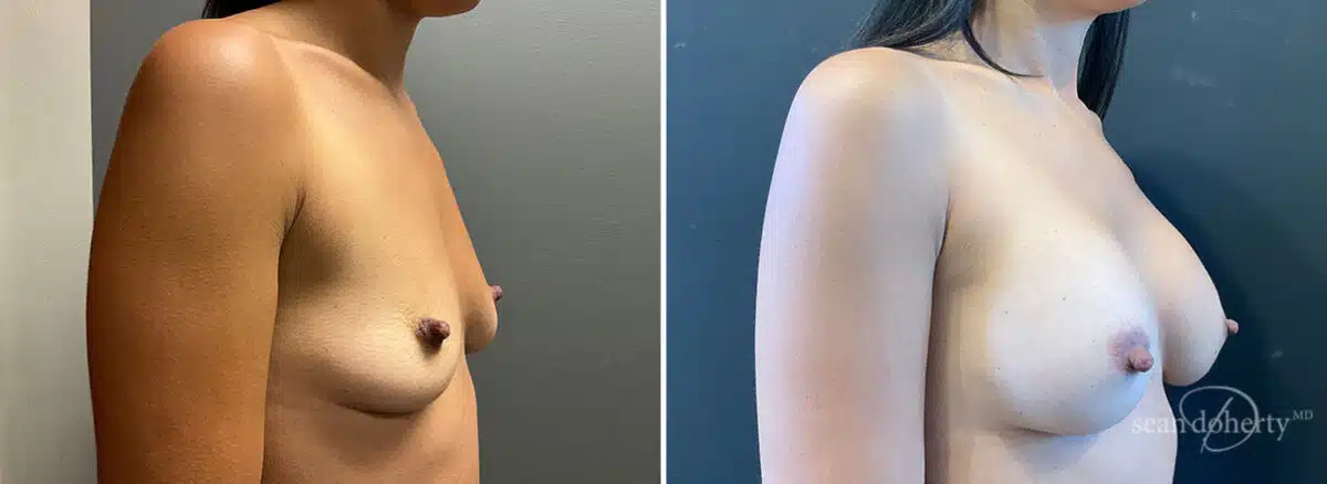 Patient 10941, Breast Augmentation Before and After Photos Breast Augmentation Before and After Photos in Boston, MA, Patient 10941