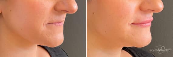 Dermal Fillers Before and After Photos in Boston, MA, Patient 10960