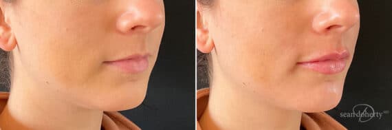 Dermal Fillers Before and After Photos in Boston, MA, Patient 10970