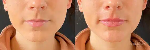 Dermal Fillers Before and After Photos in Boston, MA