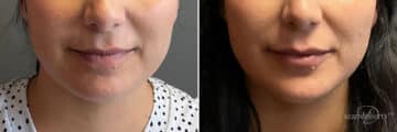 Dermal Fillers Before and After Photos in Boston, MA, Patient 10980