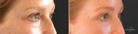Dermal Fillers Before and After Photos in Boston, MA, Patient 10990