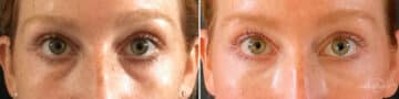 Dermal Fillers Before and After Photos in Boston, MA, Patient 10990