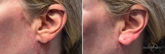 Dermal Fillers Before and After Photos in Boston, MA, Patient 10997
