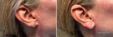 Dermal Fillers Before and After Photos in Boston, MA, Patient 10997