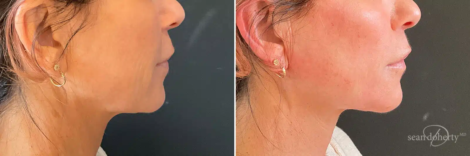 Facial Thread Lift Boston, MA,  Before and After Photos NovaThreads Before and After Photos in Boston, MA, Patient 11004