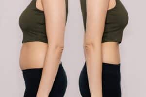 Side-by-side comparison showcasing a woman's abdominal region before and after liposuction, highlighting improved body contours.