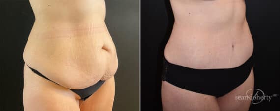 Tummy Tuck Before and After Photos in Boston, MA, Patient 11923